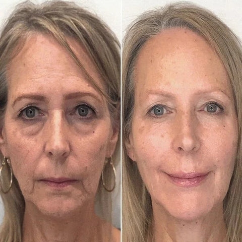Last Day Promotion 49% OFF - 🔥Botox Face Serum