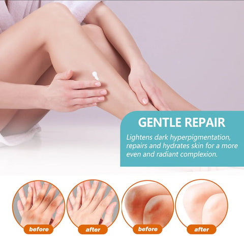 EELHOE™ Acanthosis Nigricans Therapy Cream