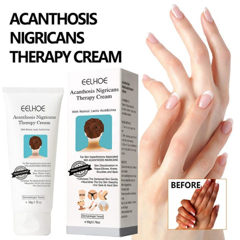 EELHOE™ Acanthosis Nigricans Therapy Cream